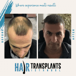 unshaven hair transplant