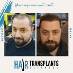 dhi hair transplant