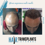 body hair transplant bht