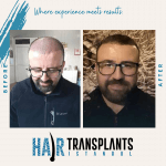 uk vs turkey hair transplant costs a complete breakdown.