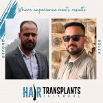 UK vs Turkey hair transplant costs a complete breakdown.