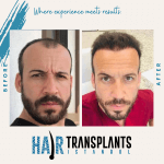 Hair transplant