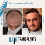 how much can canadians save on hair transplants in istanbul real numbers amp hidden costs