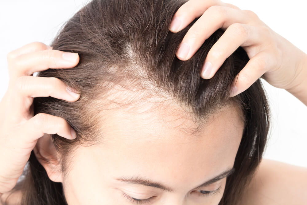 hair loss for women