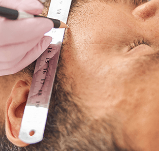 Drawing a Hair Transplant