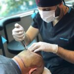 During Hair Transplant