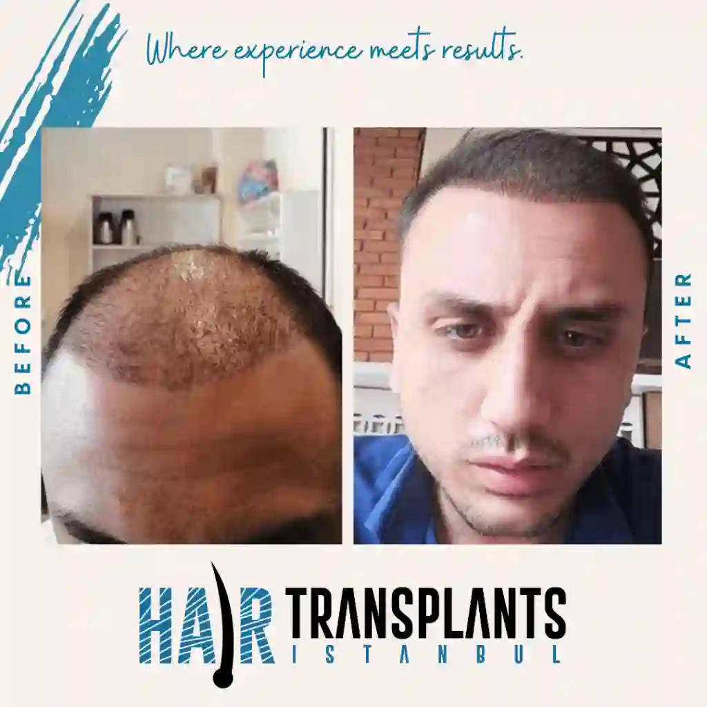 How much can Canadians save on hair transplants in Istanbul real numbers amp hidden costs.